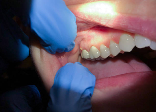 Best Emergency Wisdom Teeth Removal in Mount Healthy, OH