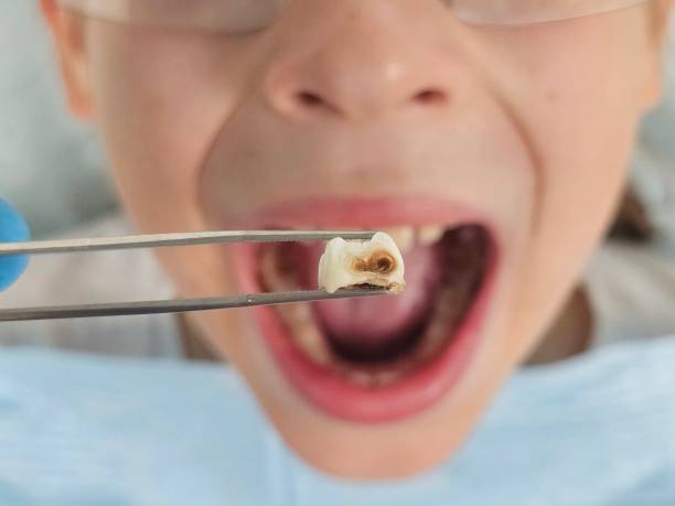 Best Emergency Tooth Extraction in Mount Healthy, OH